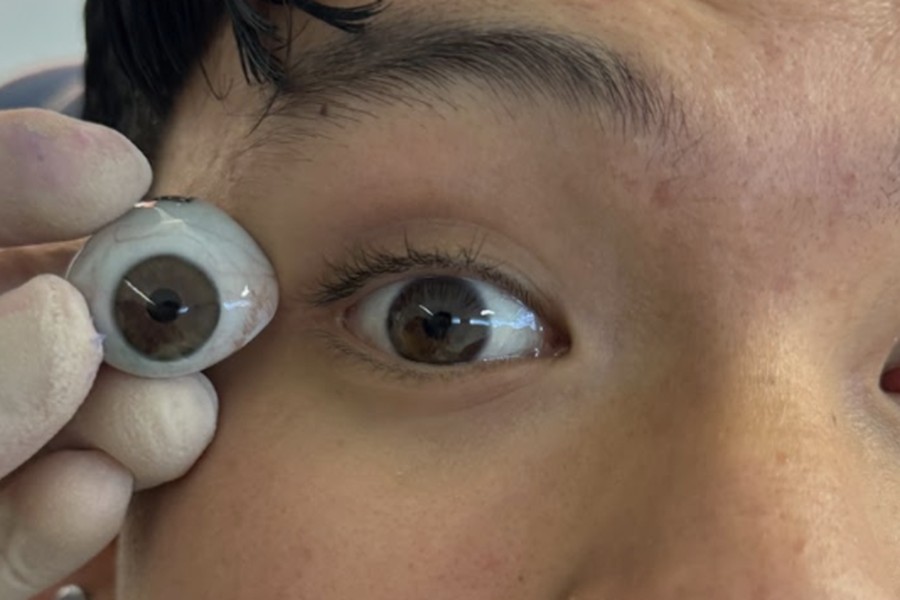 Antes — comparación de la prótesis ocular pediátrica con el ojo natural