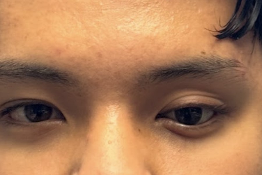 Después — resultado final de la prótesis ocular pediátrica