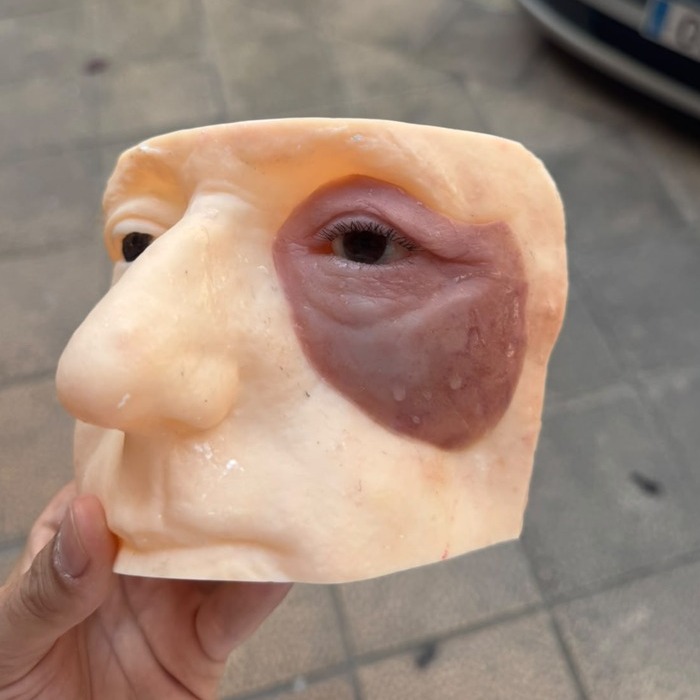 Después — epítesis facial orbitaria terminada con ojo protésico integrado