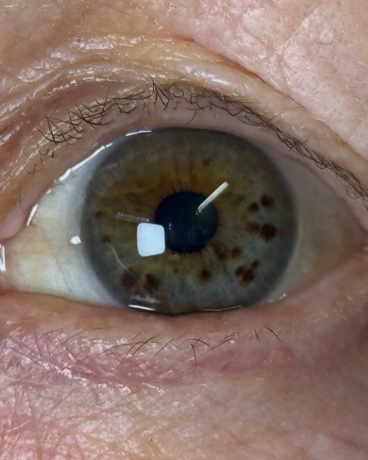 Resultado natural de una prótesis ocular total de Rubio y Quiroga Ocularistas